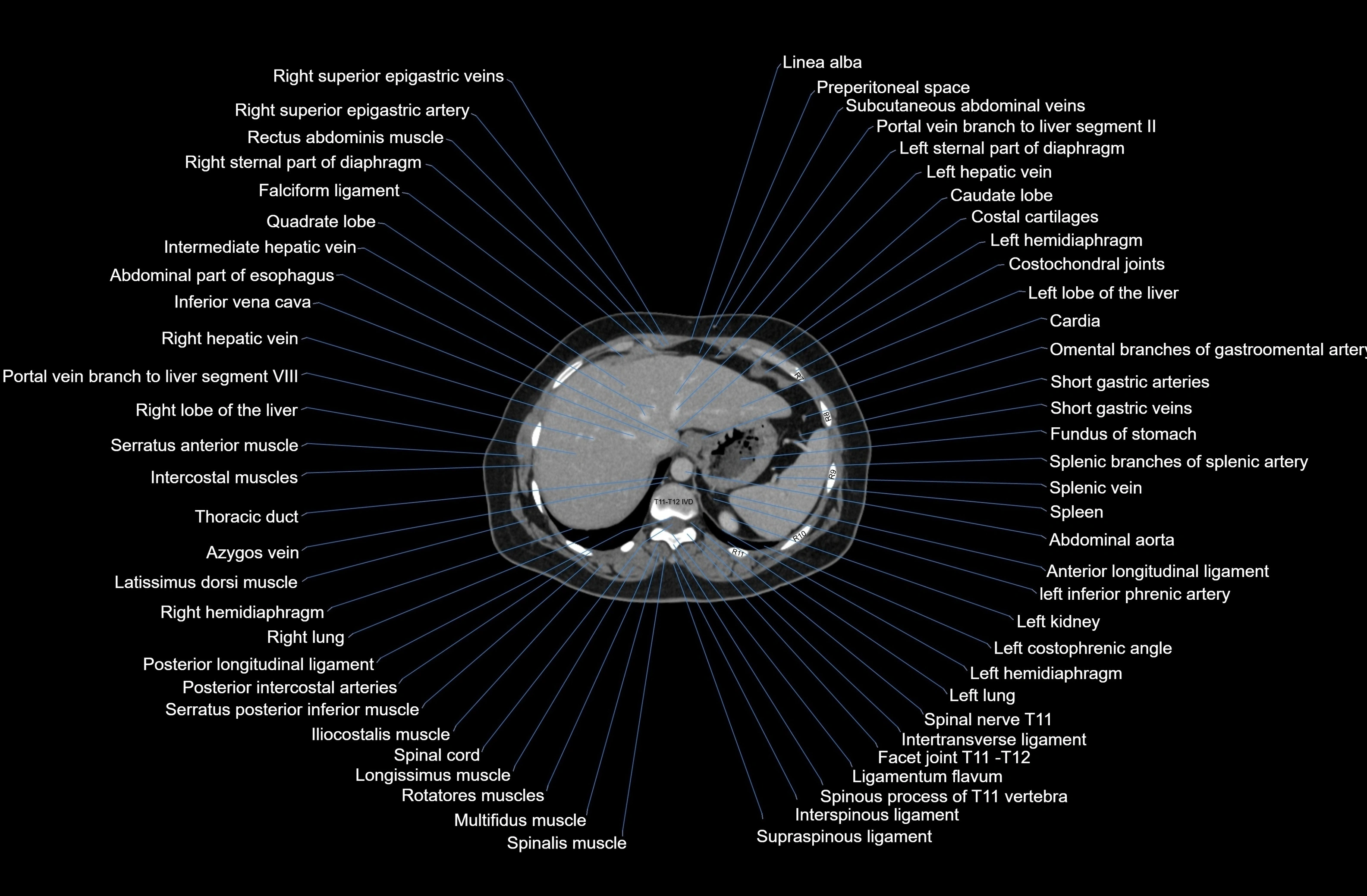 CT Abdomen axial cross sectional anatomy labelled radiology image-00014.webp